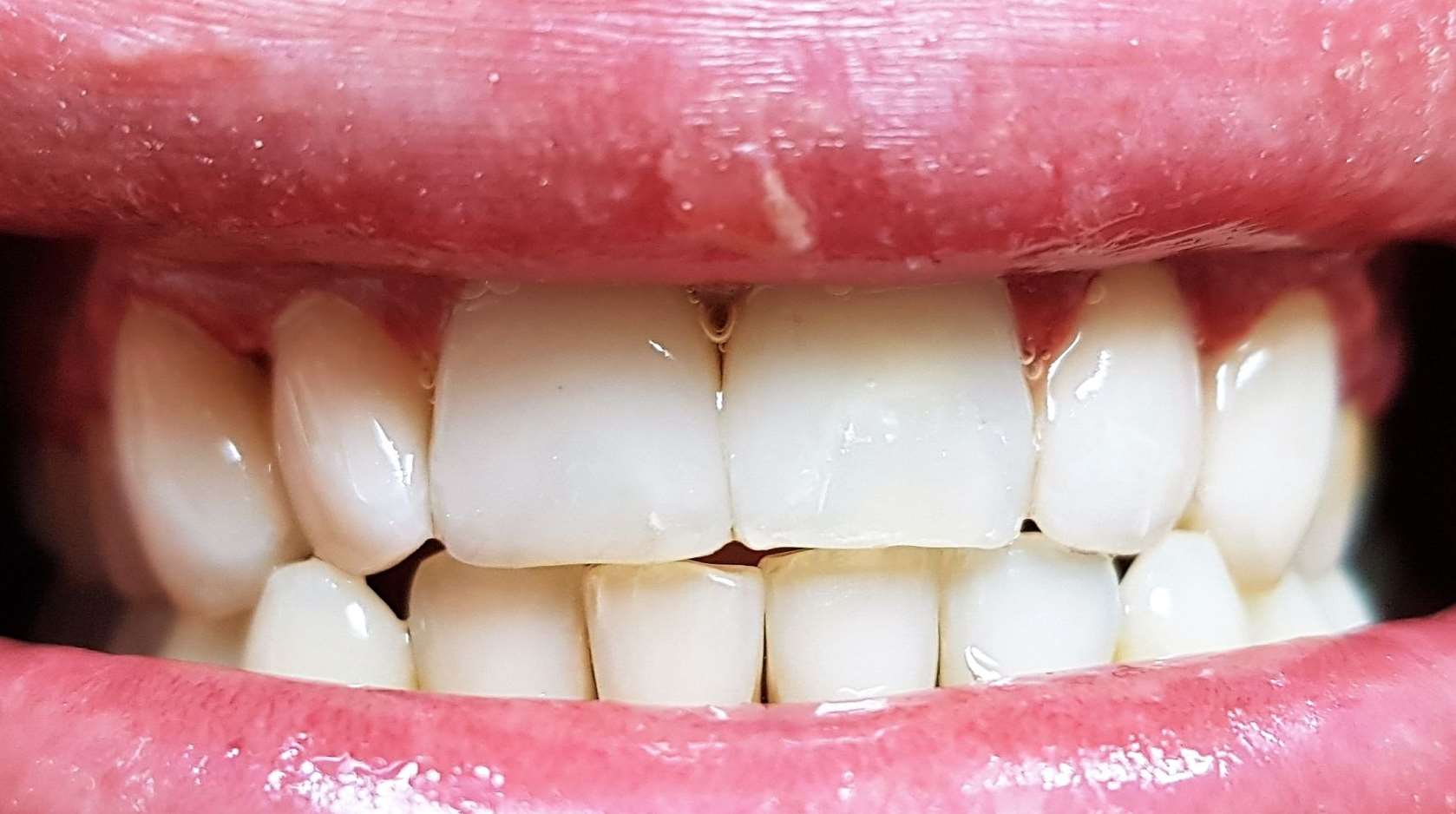 Wybielanie zębów